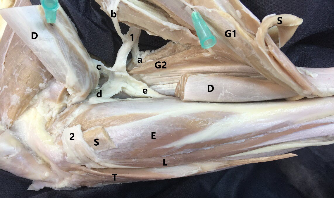 Tibial nerve